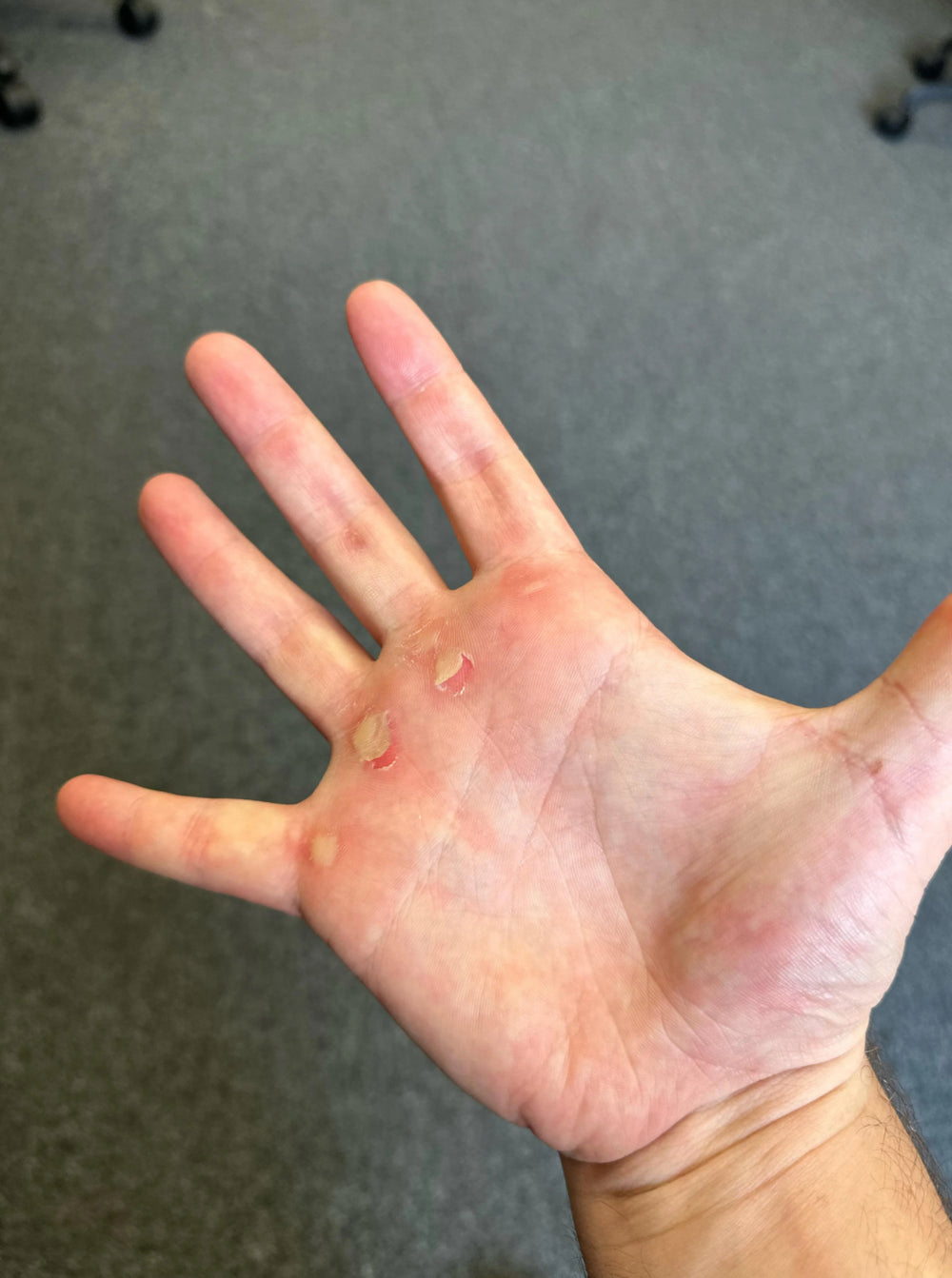 Mains déchirées et arrêts forcés